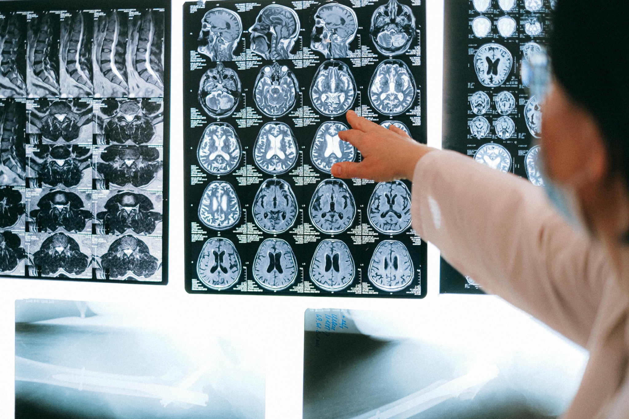 From diagnosis to chatbots: AI’s expanding role in autism care